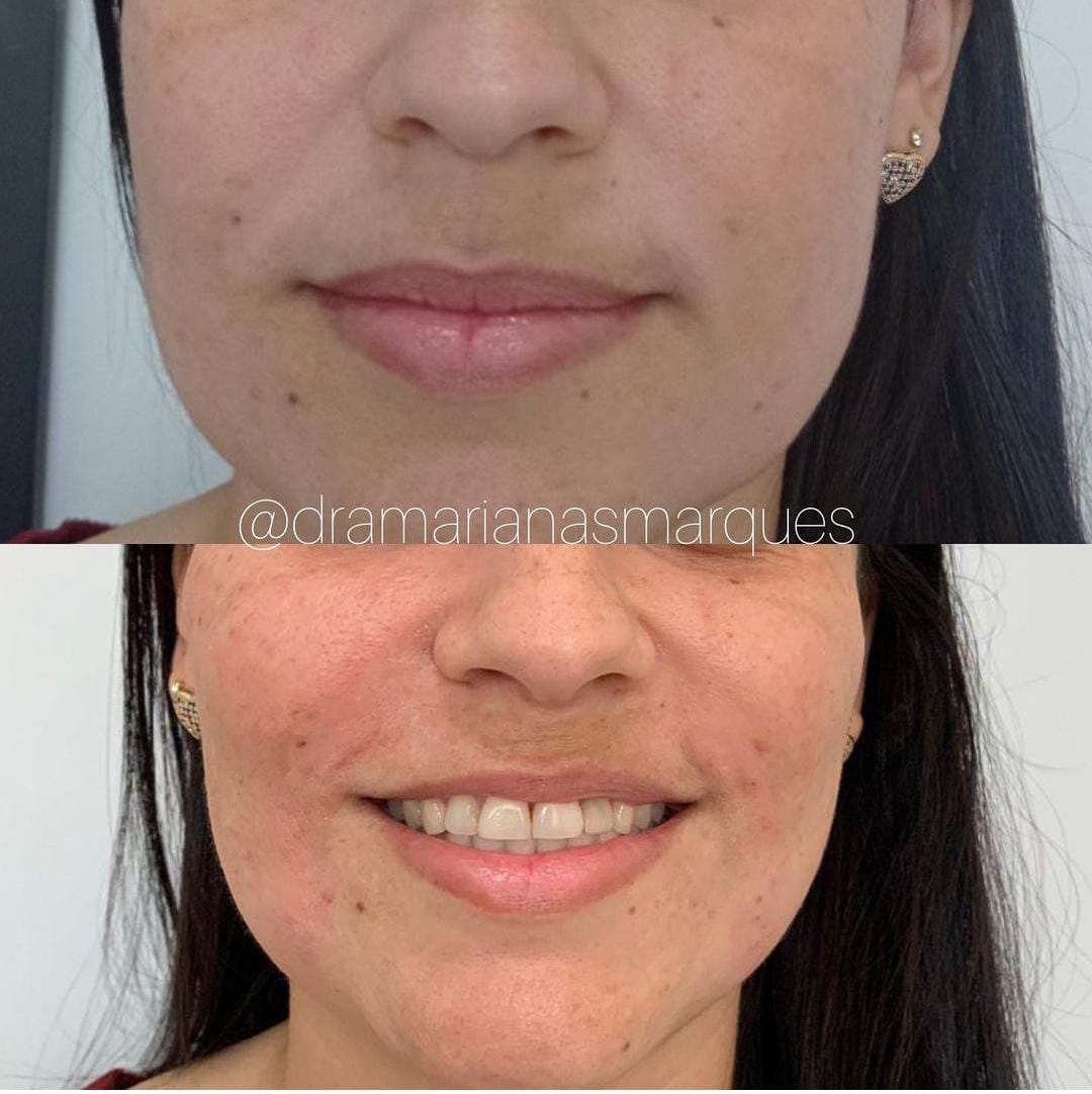 Aplicação de Radiesse para bioestimulador