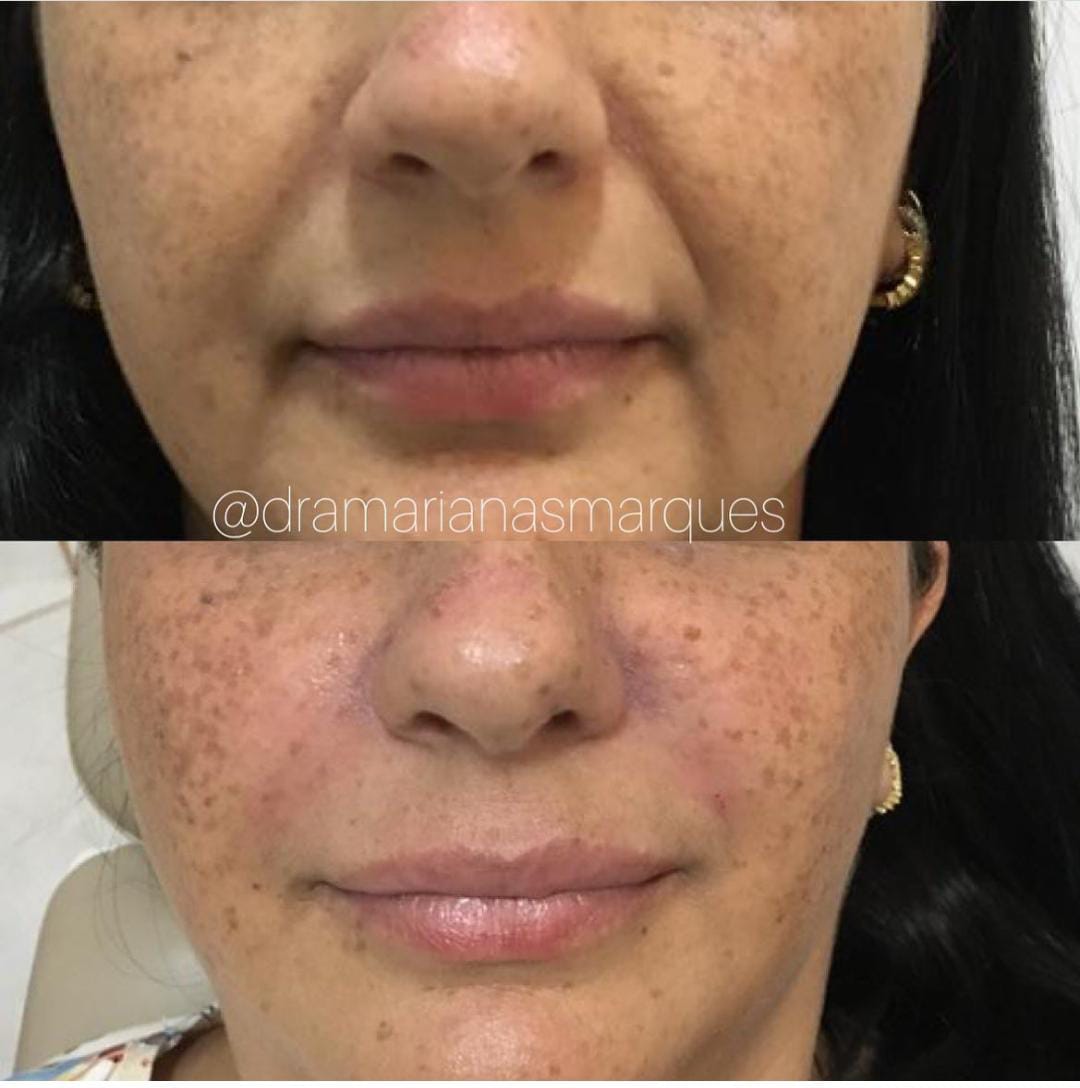 Aplicação de Radiesse para bioestimulador